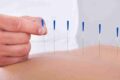 Dry needling: che cos'è e in cosa si differenzia dall'agopuntura?