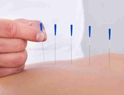 Dry needling: che cos’è e in cosa si differenzia dall’agopuntura?